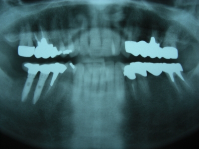 歯根破折からインプラントへ 画像2