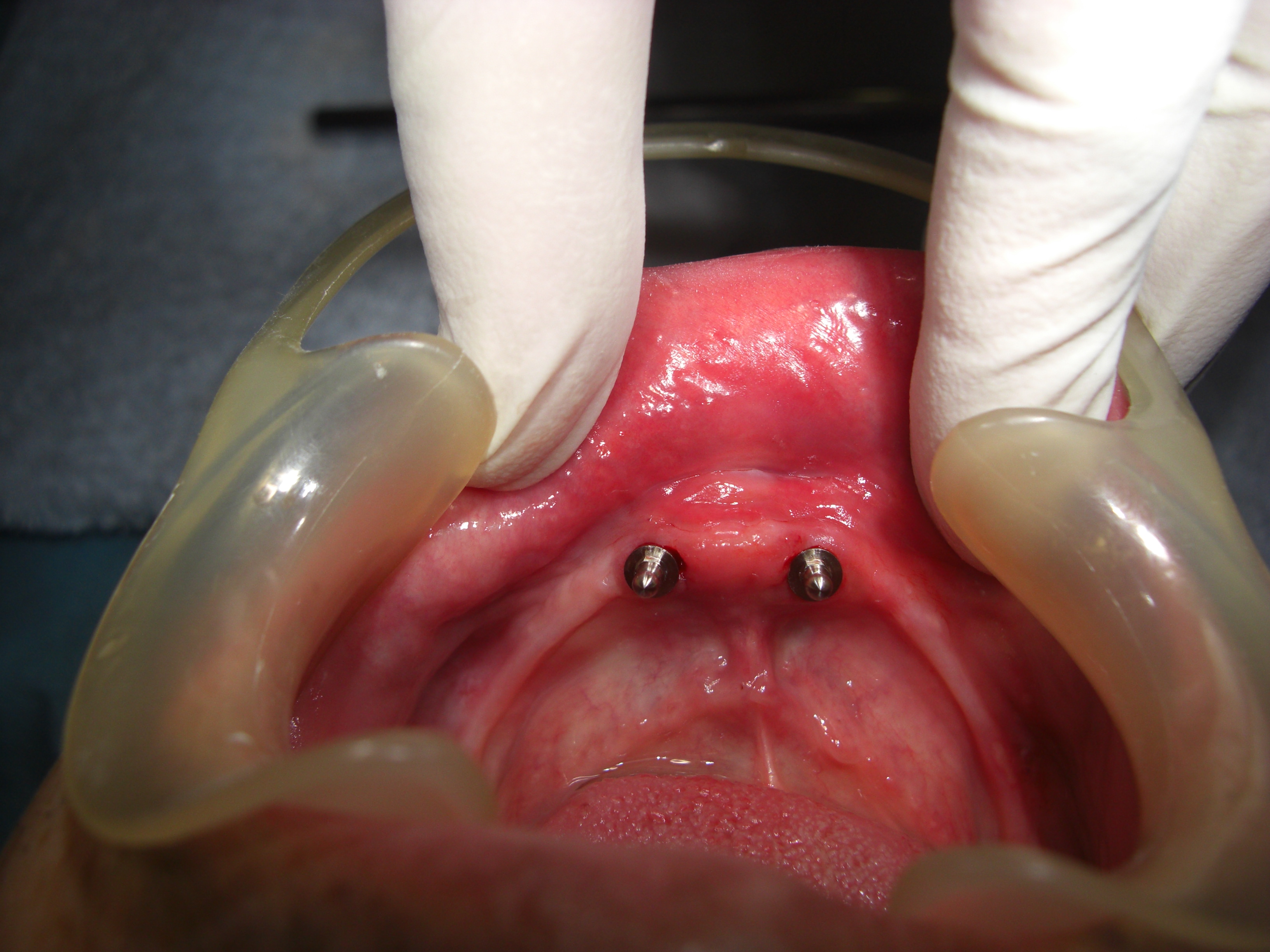 入れ歯の人工歯の排列 画像2