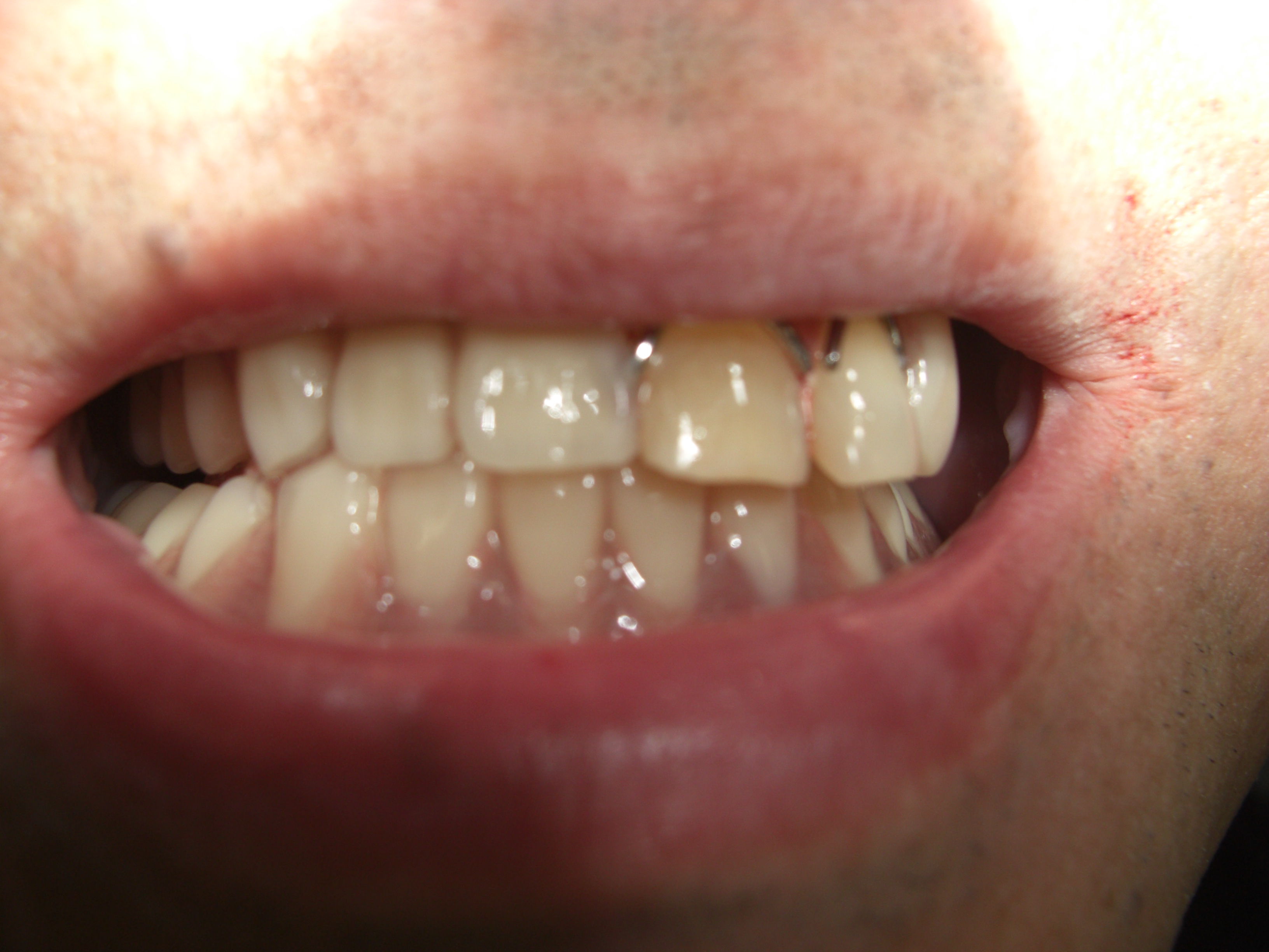 入れ歯の人工歯の排列 画像4