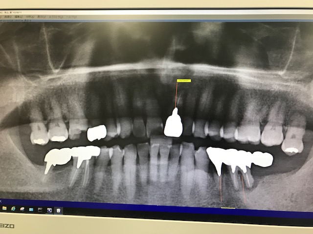 インプラントは入れて終わりではありません