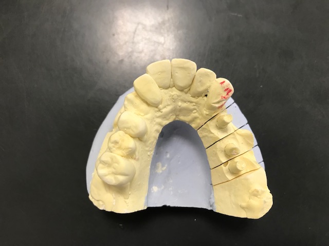 インプラント埋入時の模型