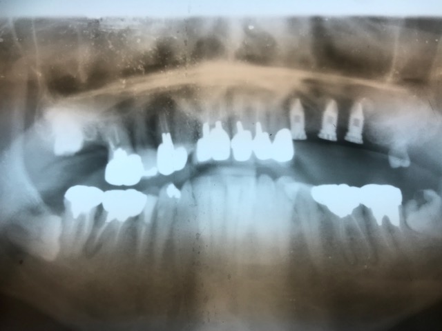 ソケットリフトしてインプラント埋入直後のレントゲン