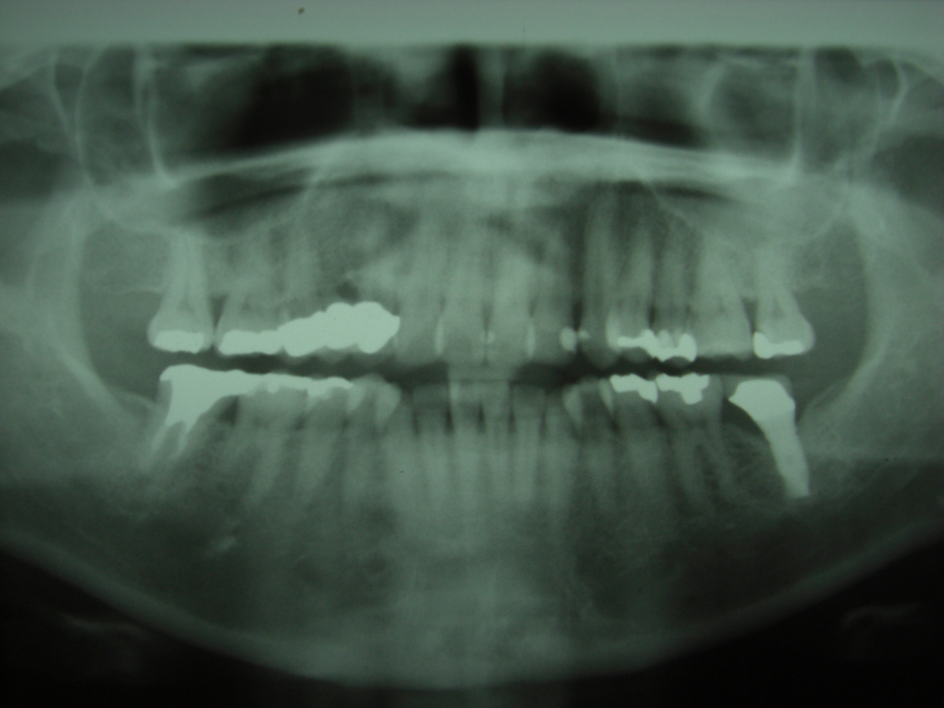 最後臼歯のインプラント 画像9