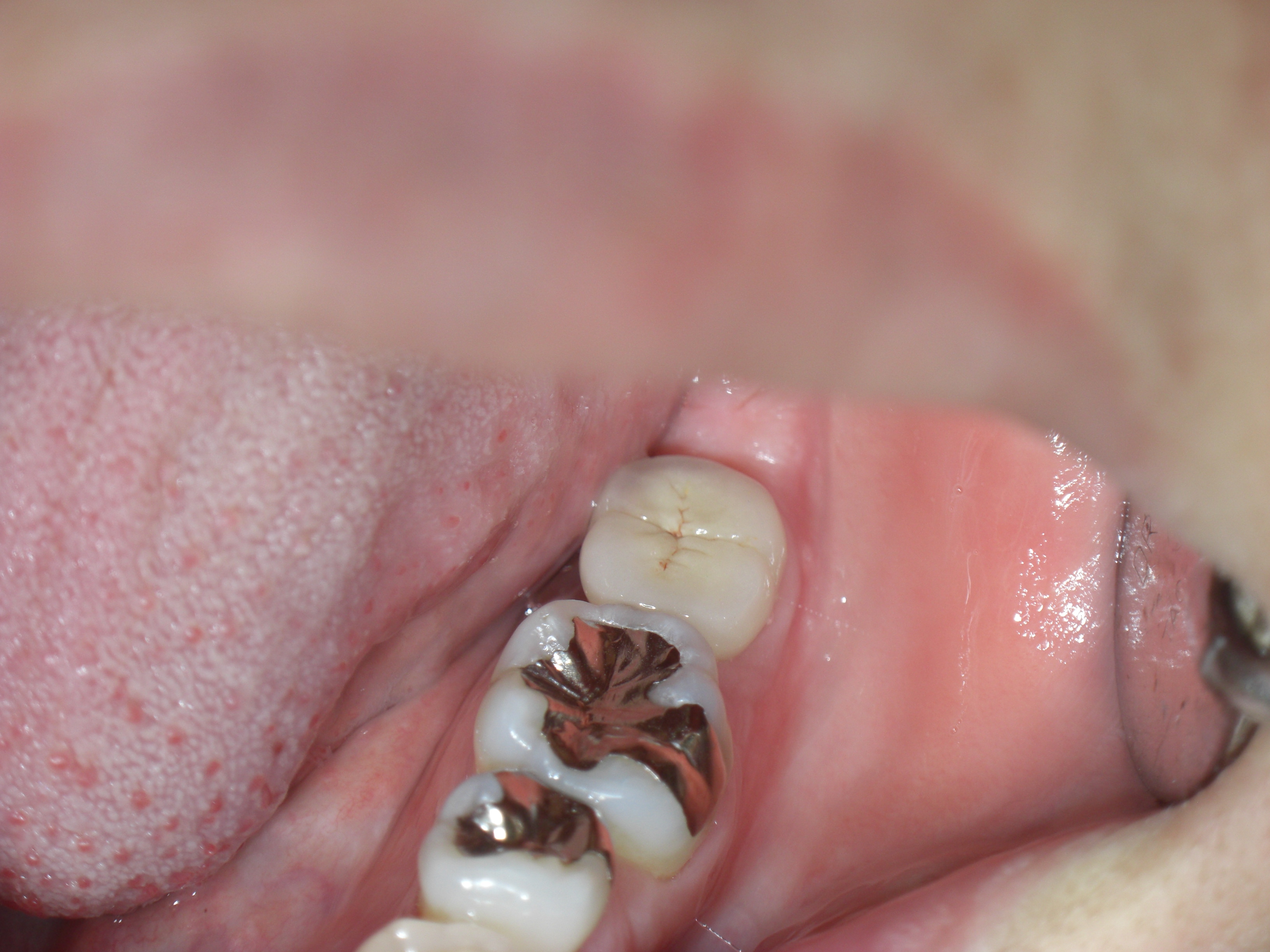 最後臼歯のインプラント 画像10