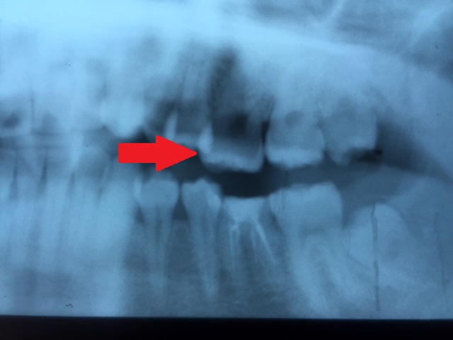 最後臼歯のインプラント 画像1