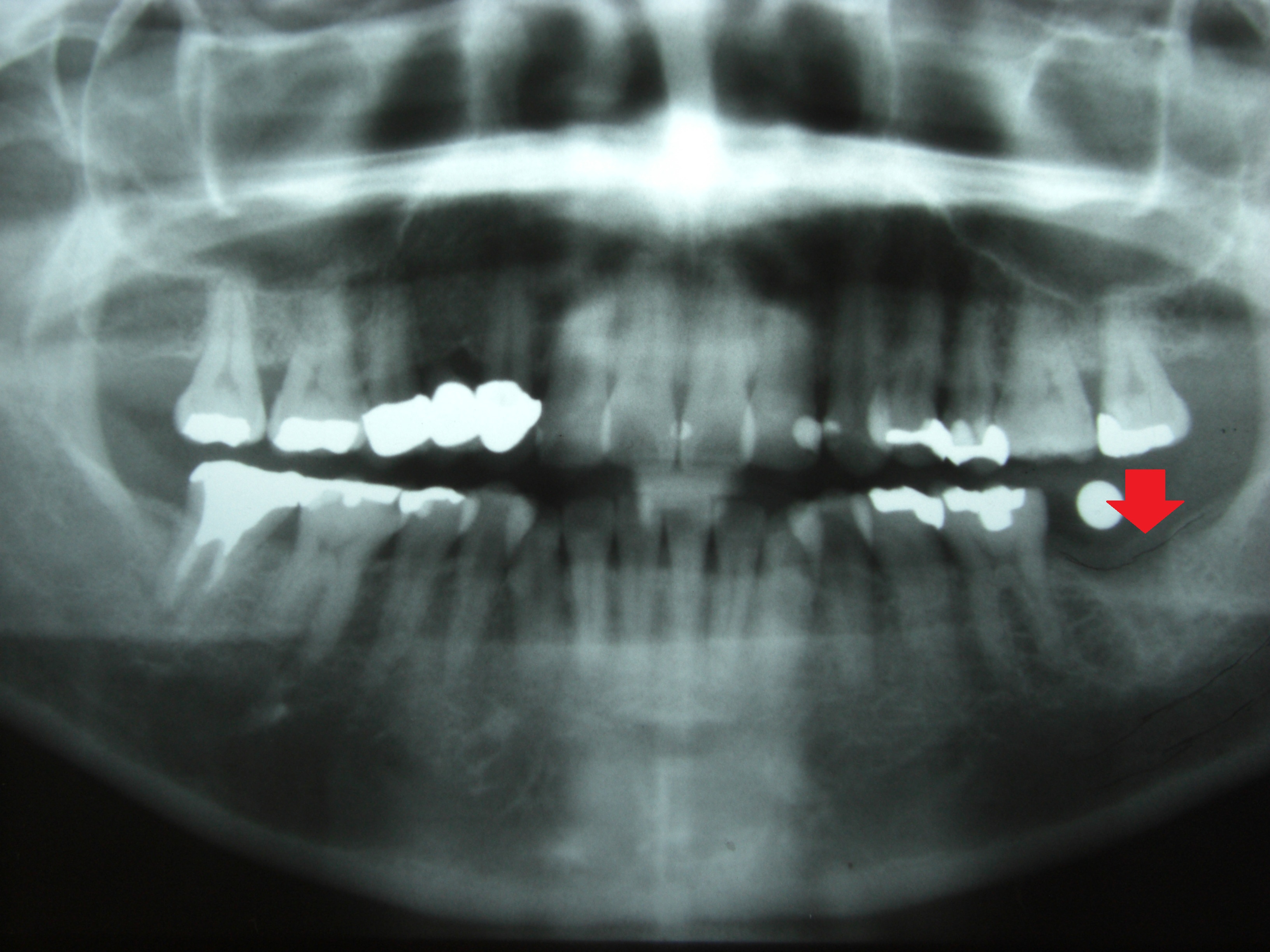 最後臼歯のインプラント 画像5